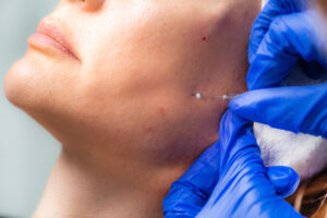 Woman recieving dermal filler treatment | Featured Image for Dermal Filler Information | Blog