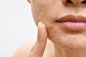 Acne and face skin problem, Woman applying acne cream medication | Featured image for treating Acne & Dealing with Acne | Blog