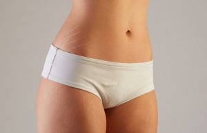 Lady with Stretch Marks | featured image for Stretch Mark Removal Blog.